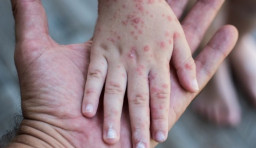 Kemenkes Keluarkan Surat Edaran Lindungi Tenaga Medis dan Tenaga Kesehatan dari Campak